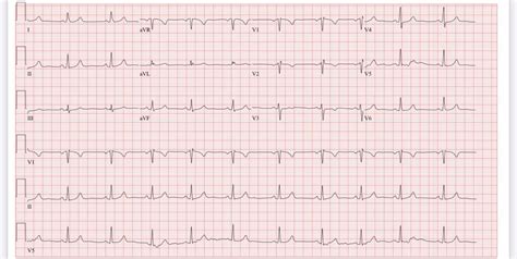 borderline ecg mayo clinic|borderline ecg left atrial enlargement.